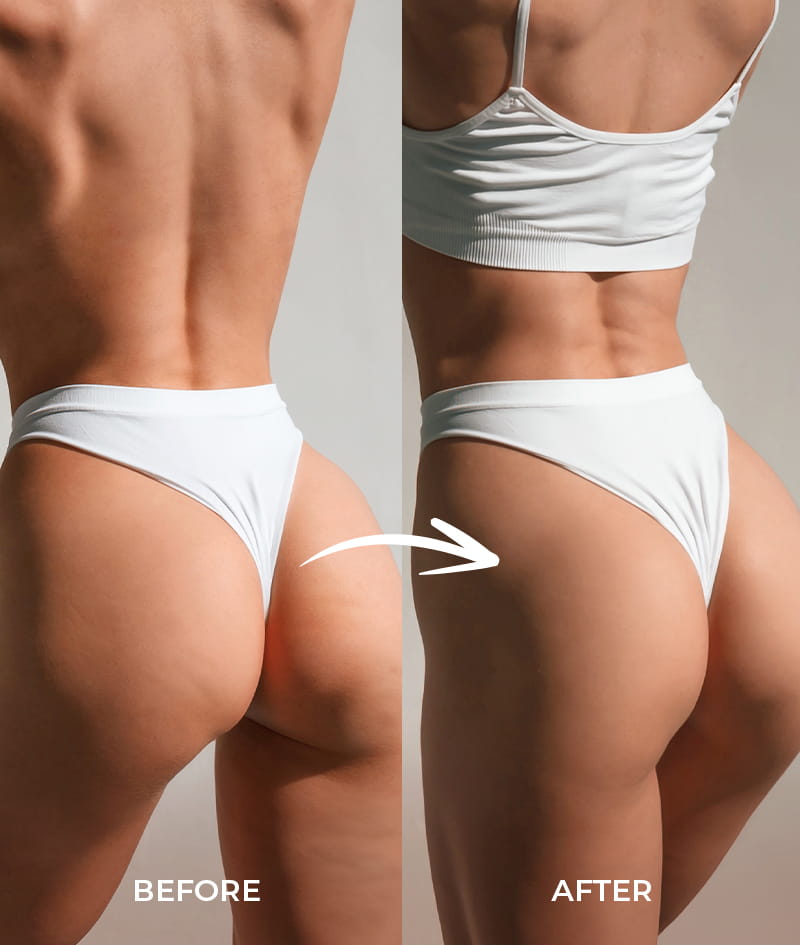 ANTI-CELLULITE THERAPY: A SKIN+ szérum 4 maximális koncentrációjú hatóanyagával láthatóan csökkenti a narancsbőrt. A SKIN Anti-cellulite száraz olaj, a BODY GUA SHA masszírozóval alkalmazva kiegészíti a narancsbőr elleni hatást és formálja az alakot.
